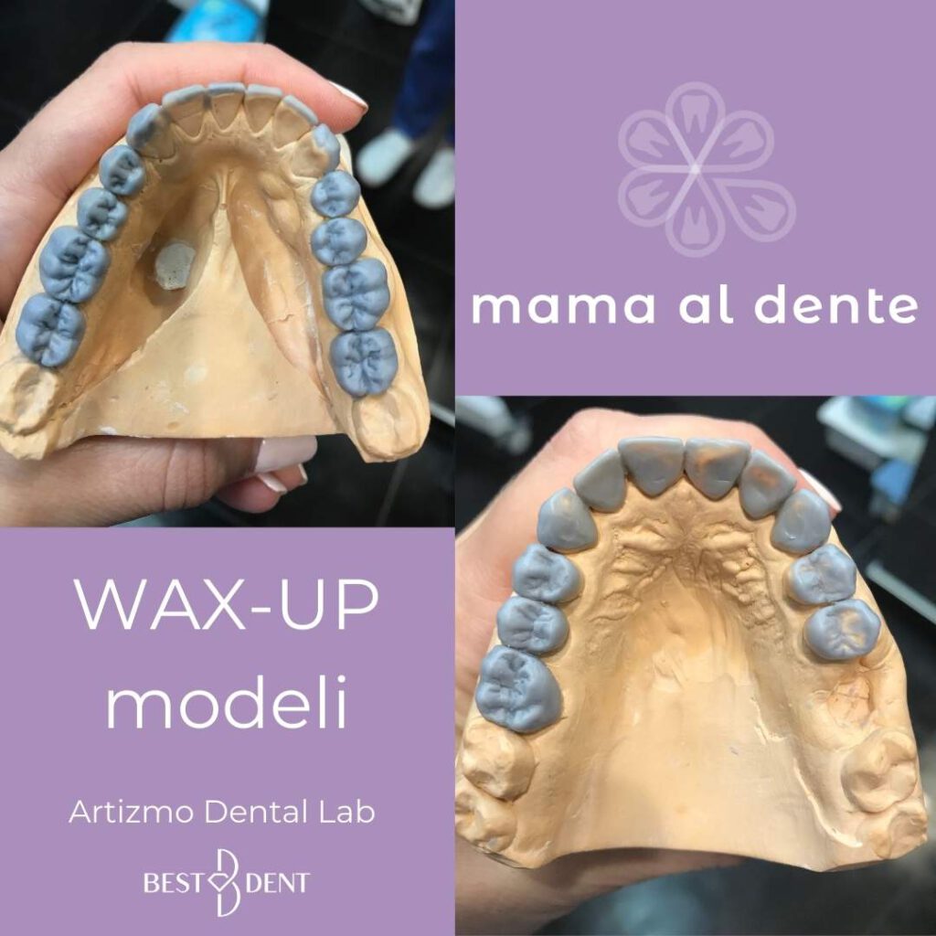 WAX-UP modeli uzębienia