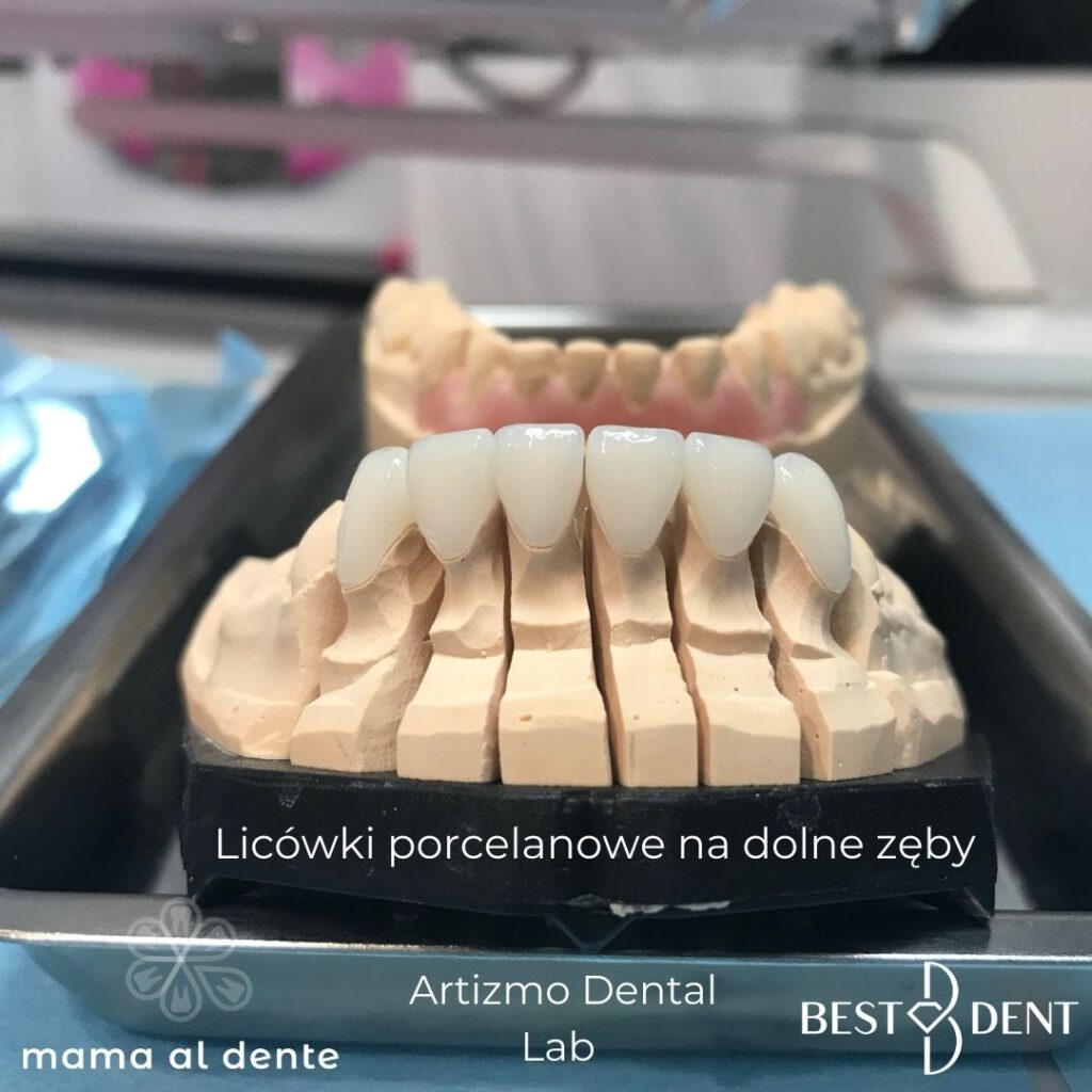 Licówki porcelanowe na dolnych siekaczach