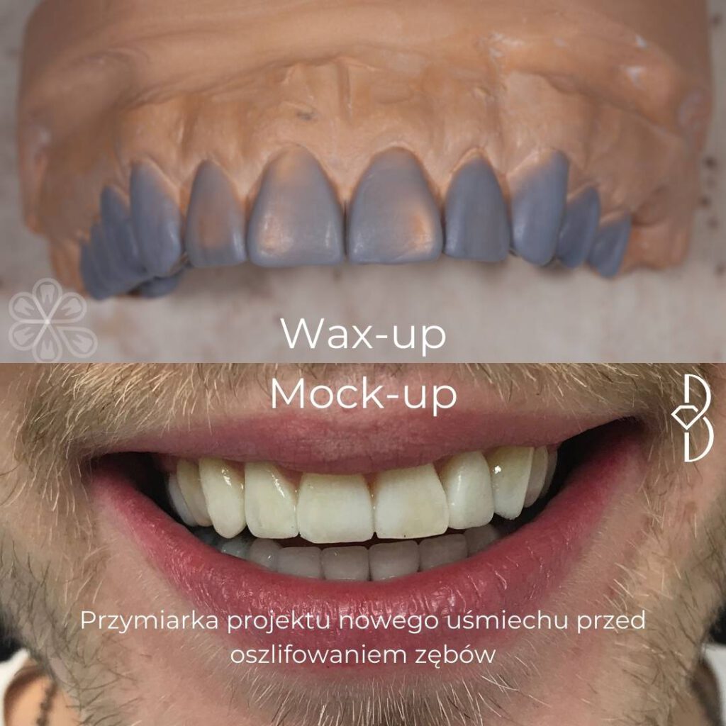 Wax-up modeli I mock-up na zębach