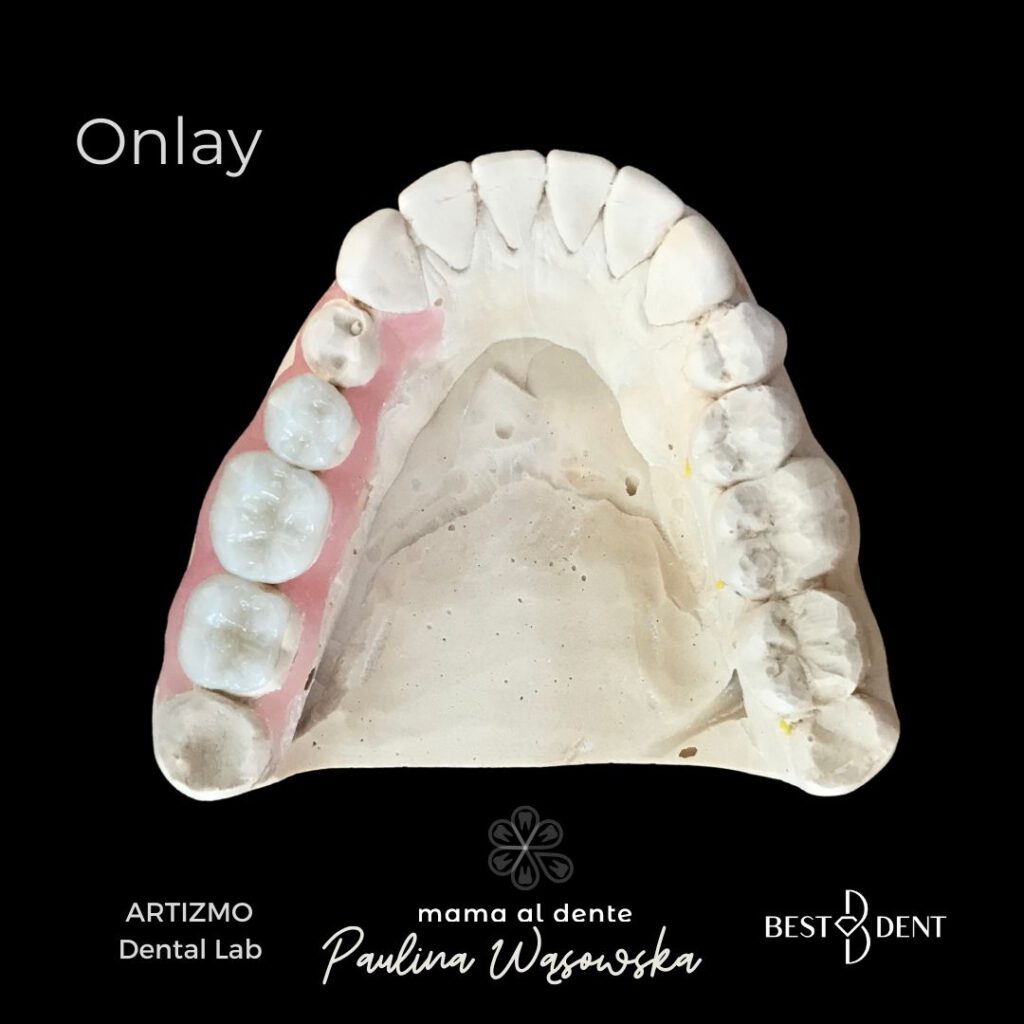 Onlay, nakład porcelanowy