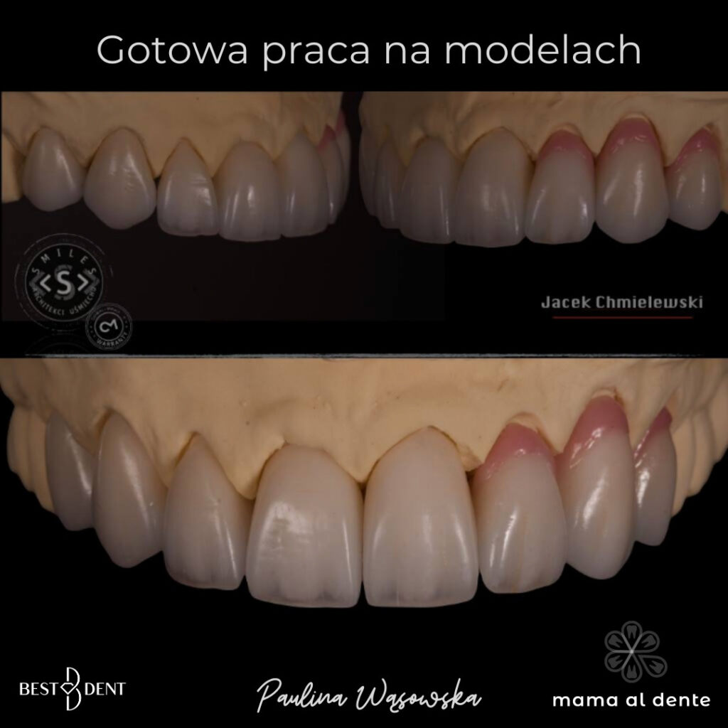 Korony pełnoceramiczne na modelu