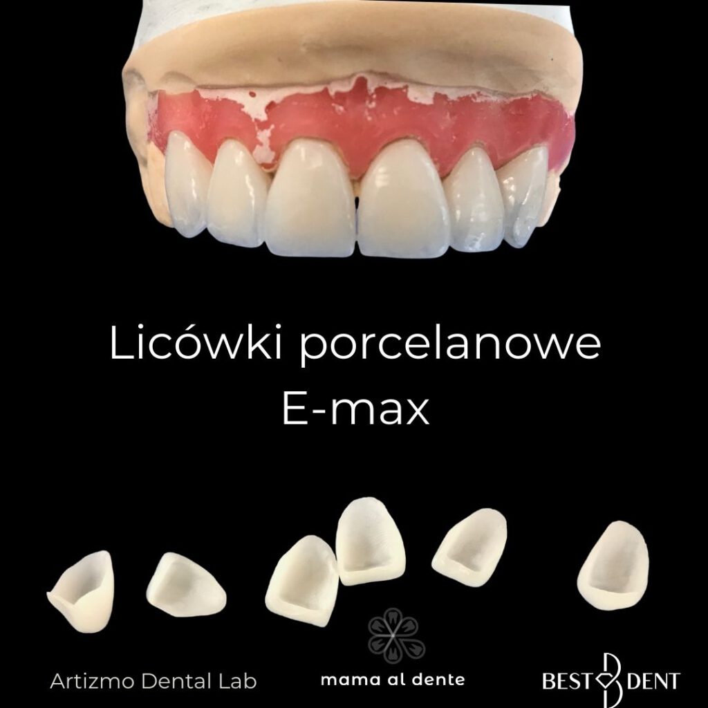 Licówki porcelanowe E-max