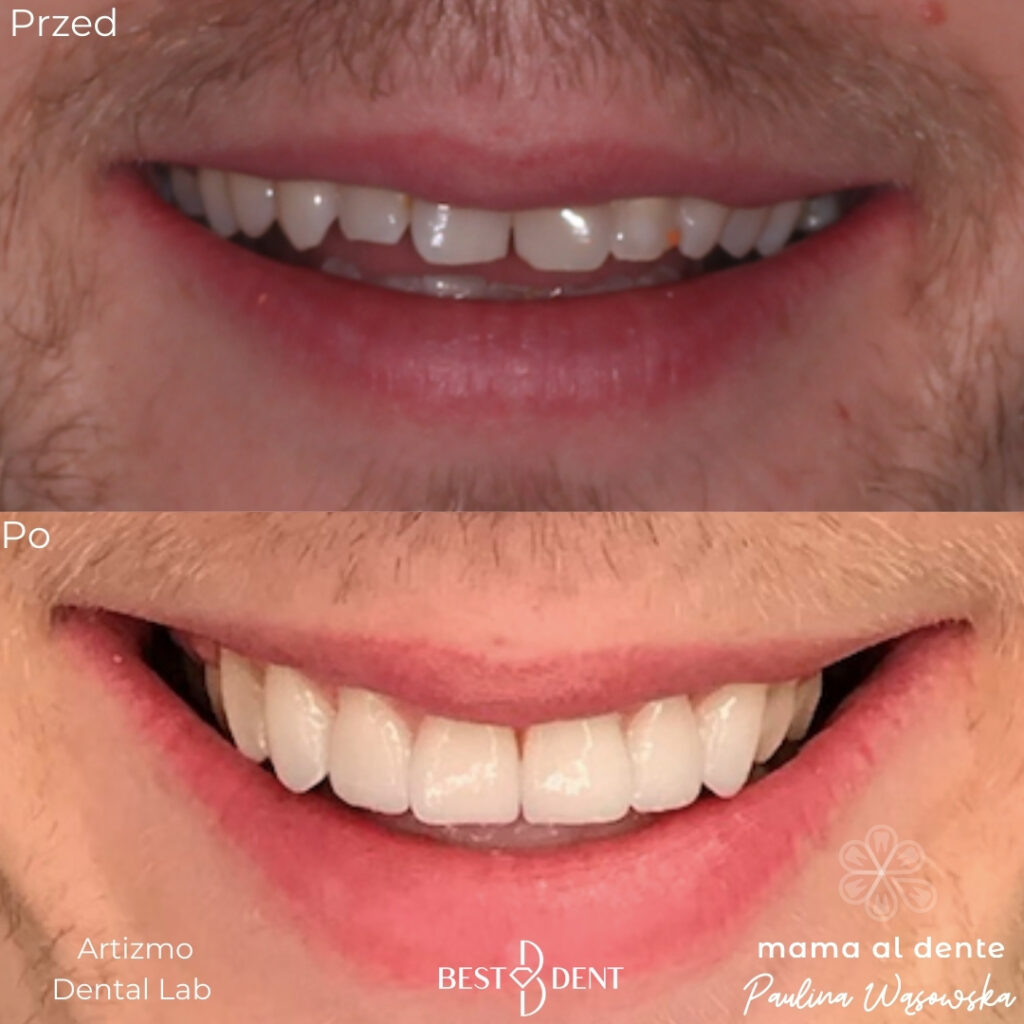 Zęby przed i po leczeniu, licówki porcelanowe
