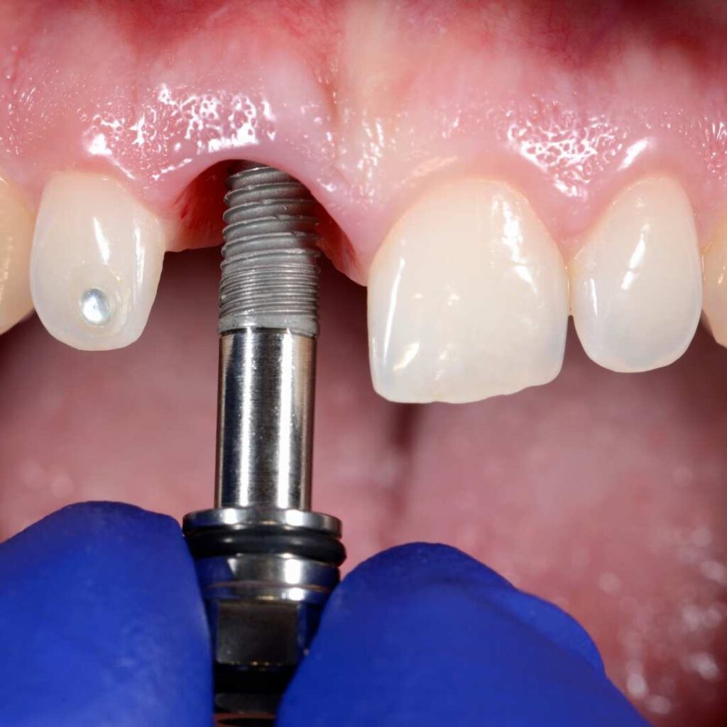 Implant zębowy