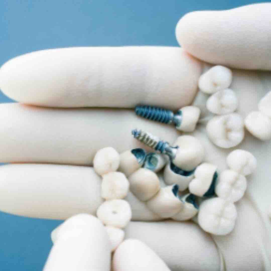Mostek czy implant?